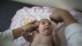 Virus zika způsobuje, že se nakaženým matkám rodí děti s výrazně menší hlavou, což je často zapříčiněno nedostatečně vyvinutým mozkem.