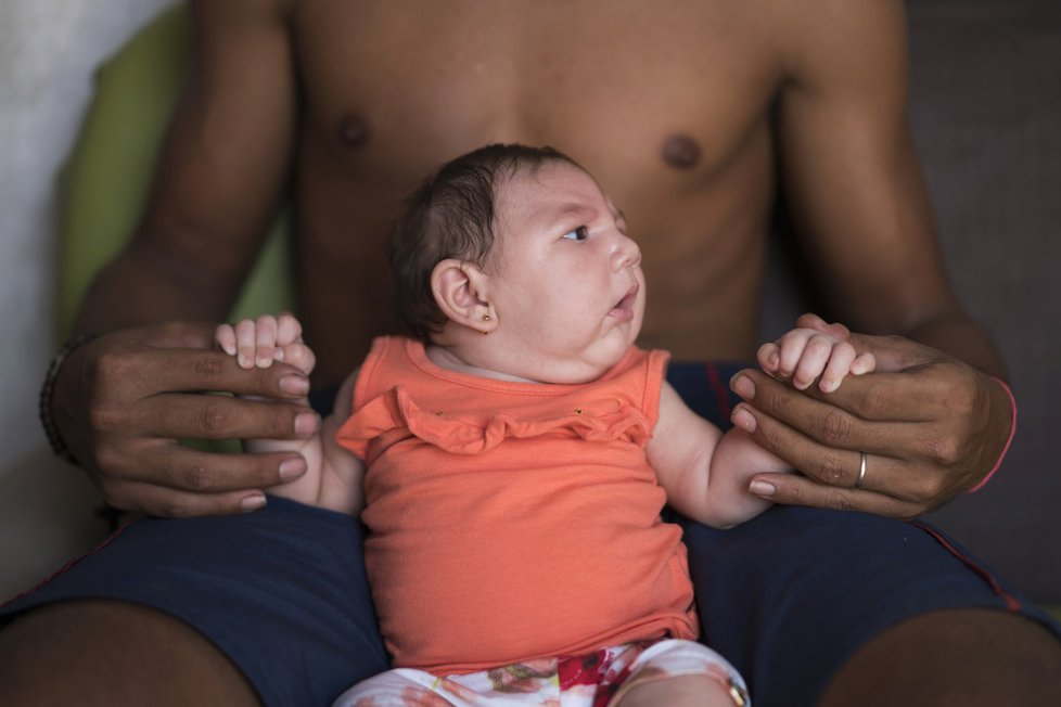 Virus Zika způsobuje, že se nakaženým matkám rodí děti s výrazně menší hlavou, což je často zapříčiněno nedostatečně vyvinutým mozkem.