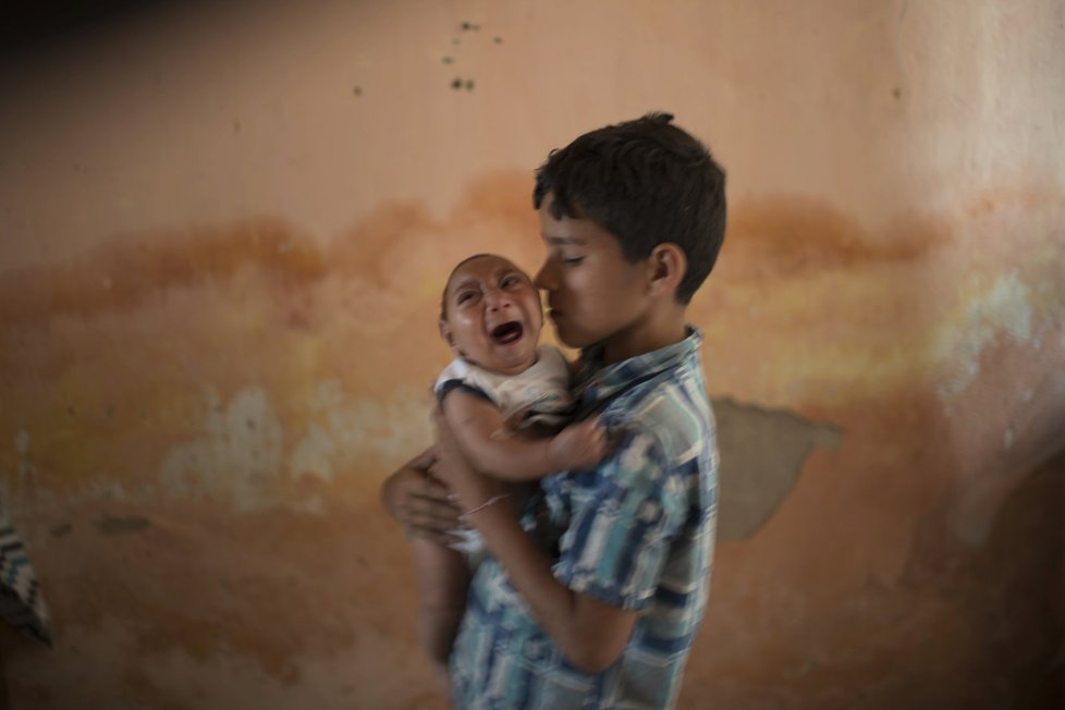 Virus zika způsobuje, že se nakaženým matkám rodí děti s výrazně menší hlavou, což je často zapříčiněno nedostatečně vyvinutým mozkem.