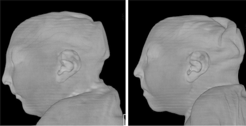 Snímky ukazují poškození hlav dvojčat, která se nakazila v 9. týdnu těhotenství virem zika. Hlavy jsou extrémně malé, mícha poškozená.
