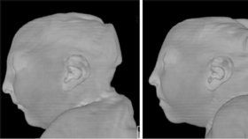 Snímky ukazují poškození hlav dvojčat, která se nakazila v 9. týdnu těhotenství virem zika. Hlavy jsou extrémně malé, mícha poškozená.