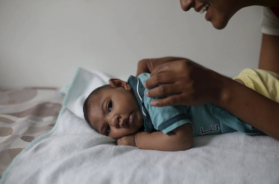 Kvůli viru zika se rodí děti s nedostatečně vyvinutým mozkem