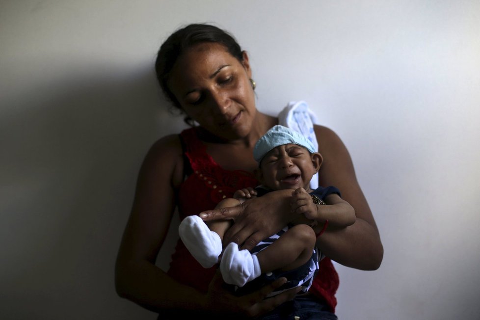Po viru zika se rodí děti se zdeformovanou hlavičkou