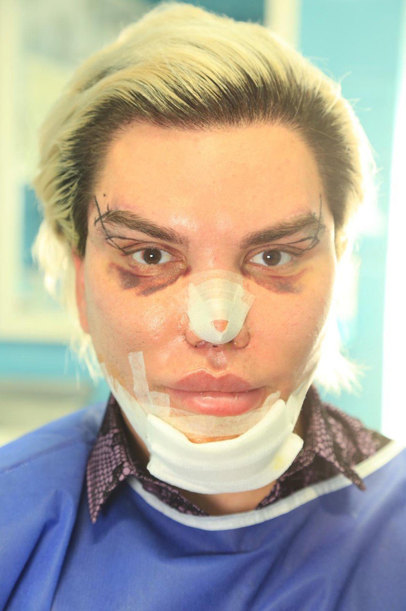 Živý Ken Rodrigo Alves se pochlubil svými posledními zákroky. Do brady si nechal voperovat implantát a nechal si vytvořit „sexy kočičí oči“.