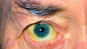 Typickým znakem žloutenky je zežloutnutí očního bělma.