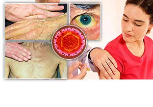 Žloutence se říká nemoc špinavých rukou. Nejúčinnější prevencí je dobrá hygiena a očkování.