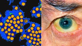 Onemocnění žloutenkou typu A se objevilo v Karlovarském kraji.