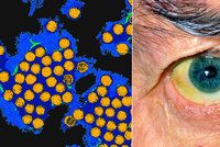 Děsivá bilance epidemie žloutenky A v Praze: Nemocných je 25krát víc než loni, 11 lidí zemřelo
