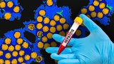 Epidemie žloutenky v Praze: Nakazilo se 826 lidí, deset z nich zemřelo
