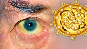 Žloutenka zabíjí i v době covidové