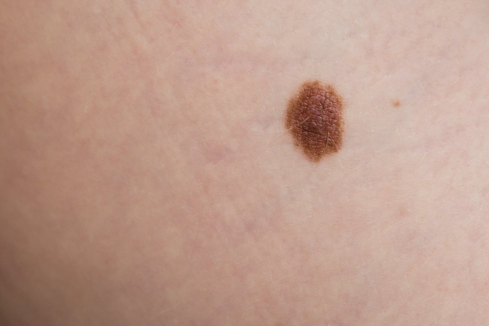 Mateřské znaménko (tvz. pigmentový névus) je kožní projev vznikající zmnožením melanocytů, což jsou buňky, které produkují pigment.