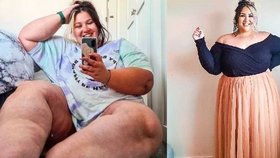 Zoe (29) má extrémně zvětšené nohy lipedémem. Fotí se na instagram, aby ženy nedopadly jako ona.