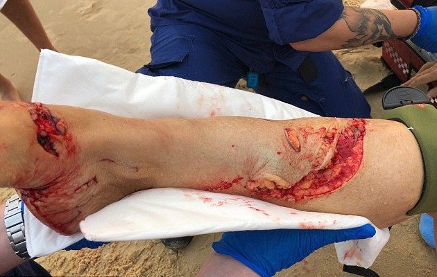Žralok ženě ošklivě pokousal nohu.