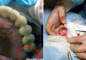 Ruskému chlapci vyoperovali lékaři z varlete zub.