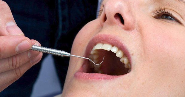 Změna u zubaře: Amalgám „na pojišťovnu“ bude jen v kapslích, pro děti a těhotné vůbec