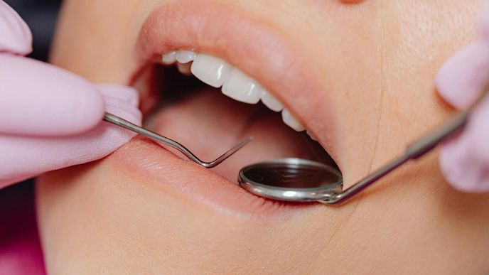 Nepodceňujte zubní kámen Nepodceňujte zubní kámen