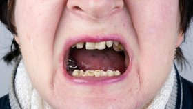 Nečištění zubů může vést k vážným zdravotním problémům.