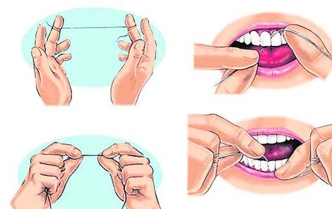Jak nit používat? 1. Připravte si asi 30 cm nitě a otočte ji okolo prostředníku na každé ruce. Při čištění horních zubů vezměte nit mezi ukazovák a palec  tak, aby napnutá mezi palci byla dlouhá asi 2 cm.  2. Při zavádění nitě mezi zuby v dolním oblouku napněte nit mezi ukazovákem a palcem tak, abyste na ni ukazovákem tlačili. 3. Jemně pohybujte nití obtočenou okolo zubu směrem nahoru a dolů. Nikdy nepoužívejte řezací pohyb (směr zepředu dozadu).