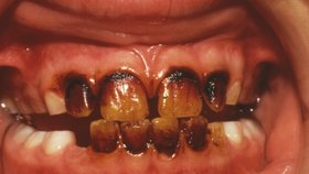 Zkažené zuby (ilustrační foto)