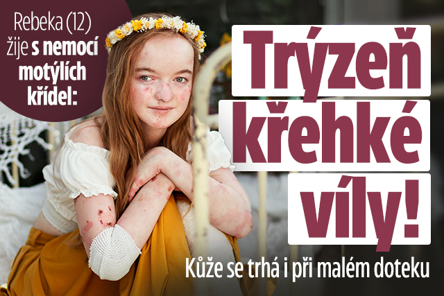 Banner ke žhavému tématu: Rebeka žije s nemocí motýlích křídel: ...